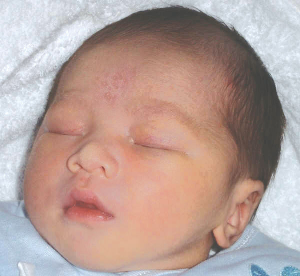 Showing neonatal acne over the forehead of a baby