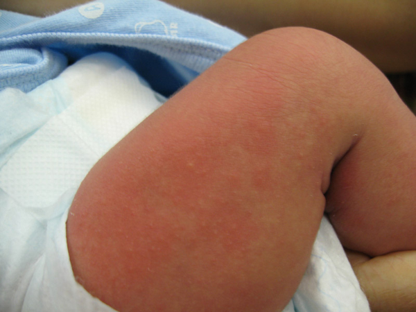 Showing erythema toxicum over the thigh of a baby