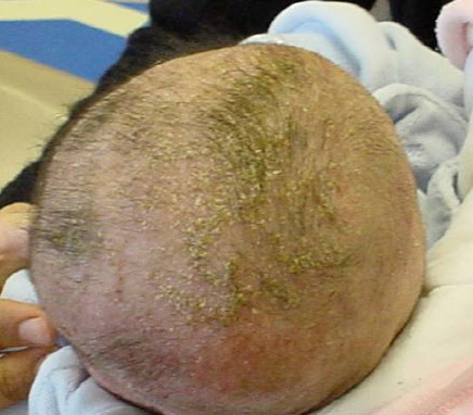 Showing seborrhoeaic dermatitis over the scalp of a baby
