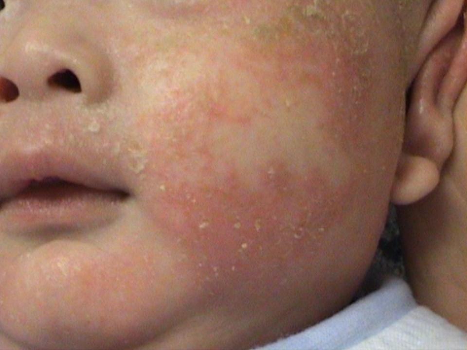 Showing infantile eczema over the back of knee of a child
