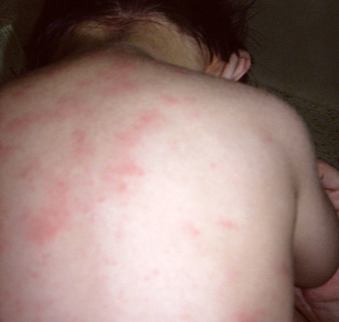 Showing heat rash over the back of a baby