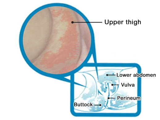 Showing diaper rash over the perineum of a baby